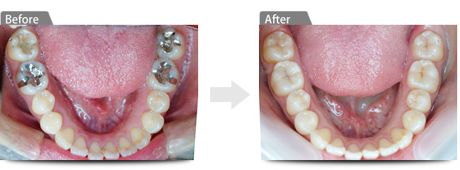 ビフォアー　アフター