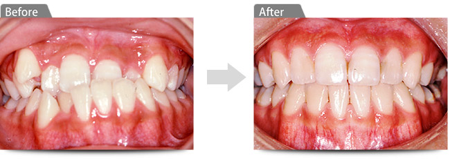 ビフォアー アフター