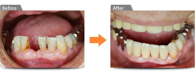 ビフォアー　アフター