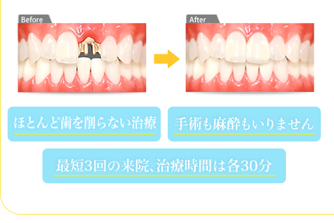 歯も骨も削らない 手術も麻酔もいりません 最短3回の来院、治療時間は各30分