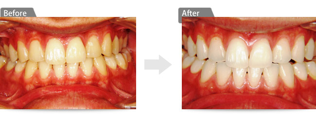 ビフォアー アフター1