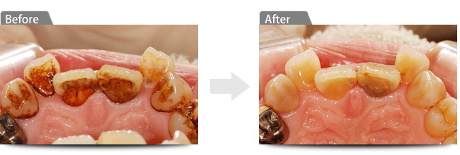 ビフォアー　アフター