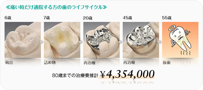 痛い時だけ通院する方の歯のライフサイクル