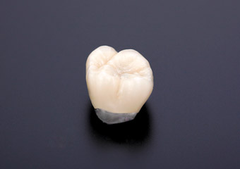 メタルボンド(奥歯)